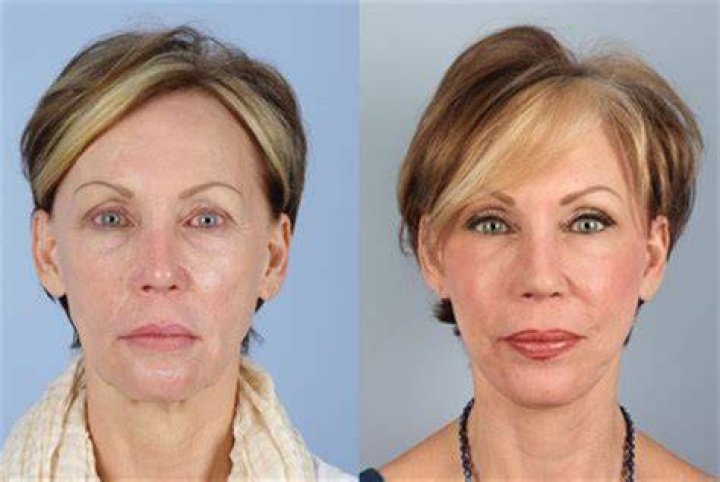 Actress Edie Falco’s Botox And Facelift, Why The Sopranos’ Fans Think She Has Done Plastic Surgery?