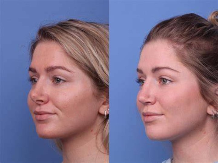 Annalisa Cochrane Nose Job and Plastic Surgery – Her “One Of Us Is Lying” Transformation