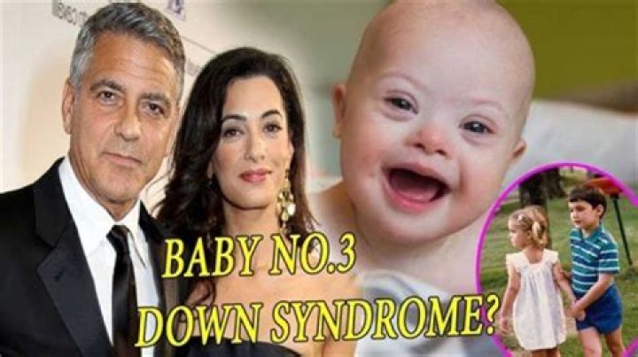 Clooney's Child: Navigating Down's Syndrome