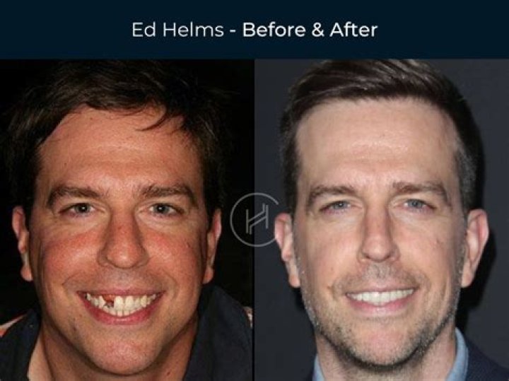 Does Freddie Freeman Have Fake Teeth? Before And After Pictures Suggests He At Least Has Veneers