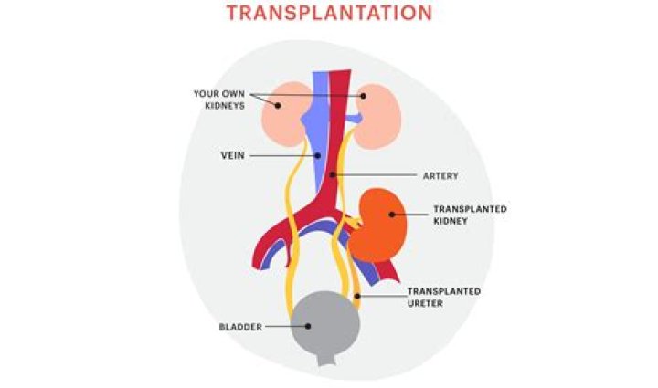 Embracing Life After Surgery: The Journey Of Healing A Kidney Transplant Scar