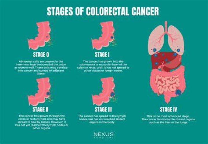 Essential Guide: "Pioneer Woman" Faces Colon Cancer Stage 4