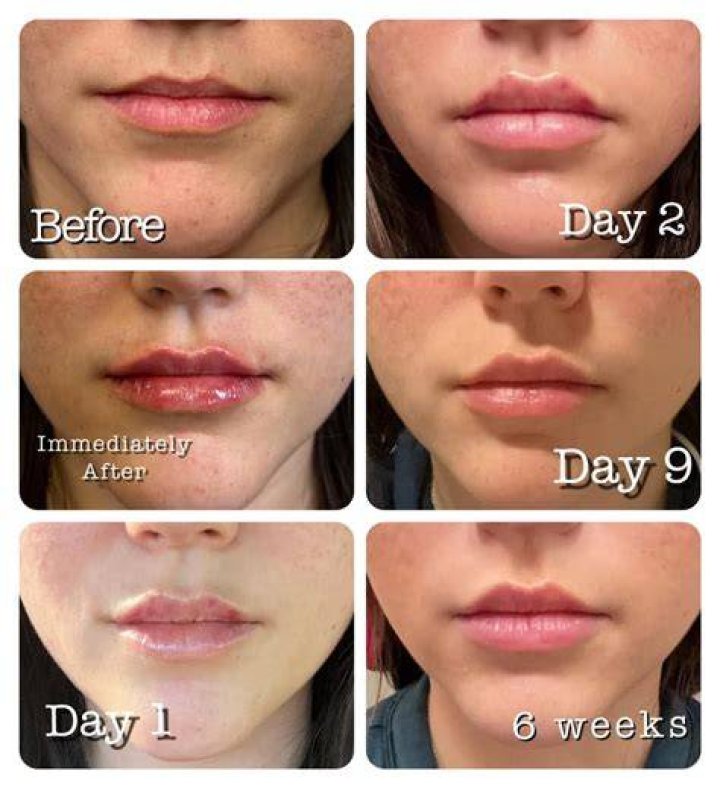 Exploring Jessica Alba's Lip Injections Journey