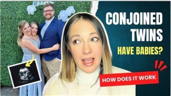 Exploring The Journey Of Conjoined Twins Pregnant: A Unique Perspective On Life And Love