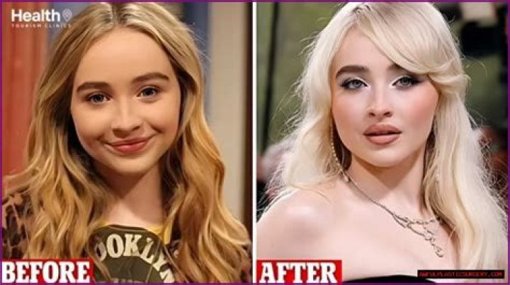 Exploring The Transformation: Sabrina Carpenter And Her Plastic Surgery Journey