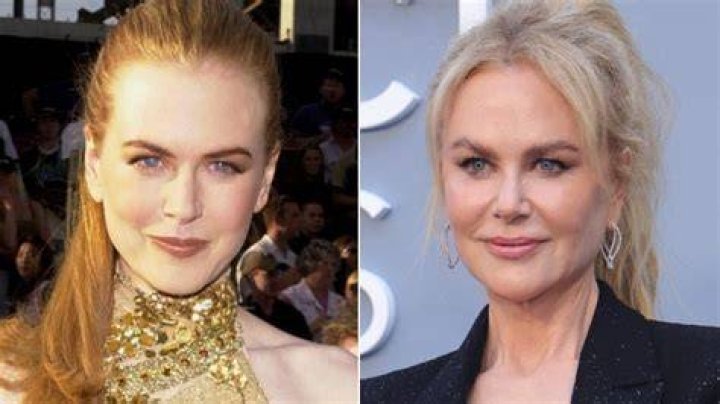 Nicole Kidman's Botox Saga: The Truth Unmasked