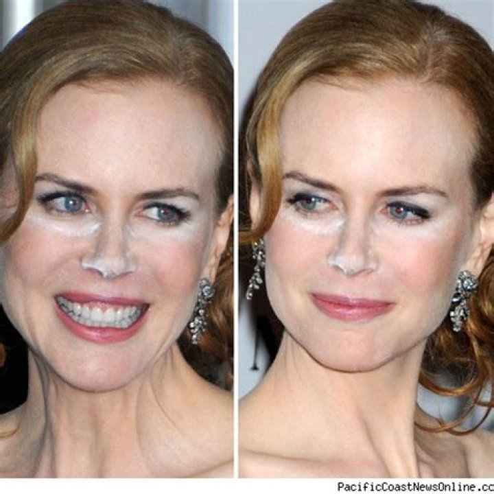 Nicole Kidman's Nose: The Cosmetic Evolution