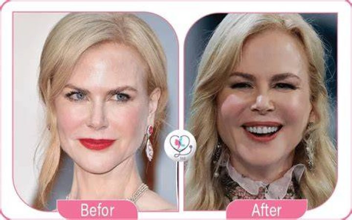 Nicole Kidman Facelift: The Truth Behind The Transformation