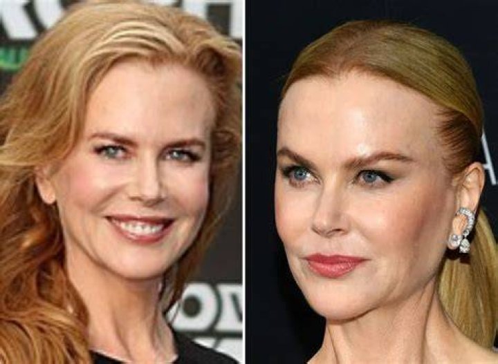 The Truth Revealed: Has Nicole Kidman Undergone Plastic Surgery?