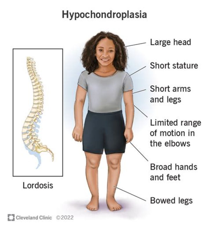 Understanding Hypochondroplasia In Babies: A Comprehensive Guide