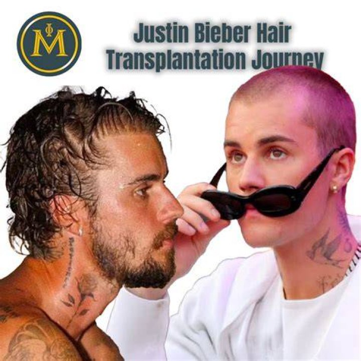 Understanding Justin Bieber's Hair Loss Journey