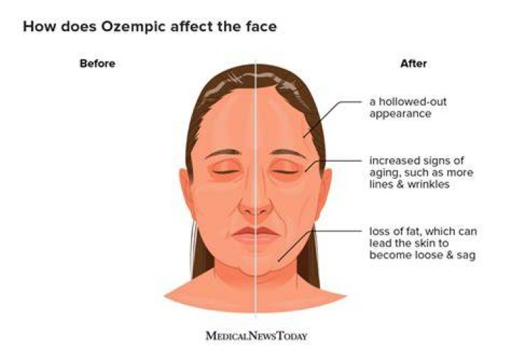 Understanding Ozempic And Its Connection To Lupus