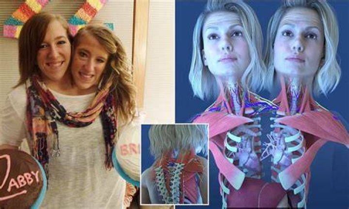 Understanding The Lives Of Abby And Brittany Hensel: The Separation Question