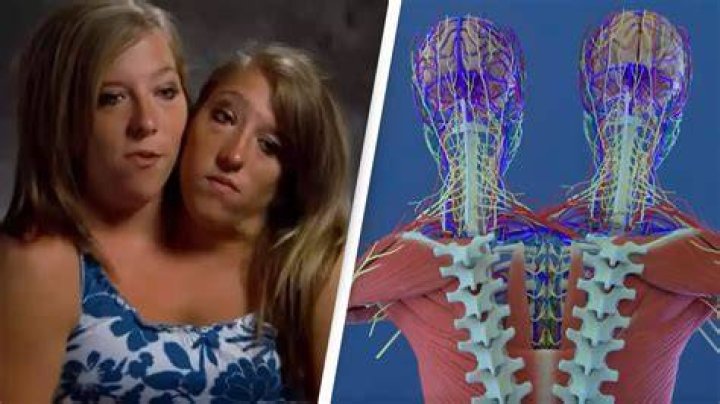 Understanding The Unique Anatomy Of Conjoined Twins Abby And Brittany