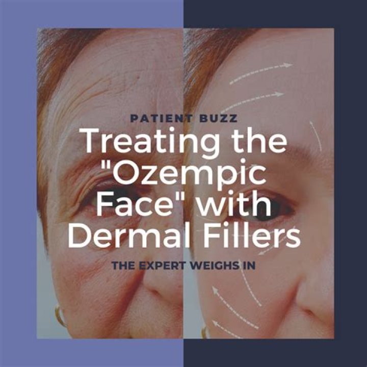 Understanding The Use Of Ozempic For Individuals With Lupus