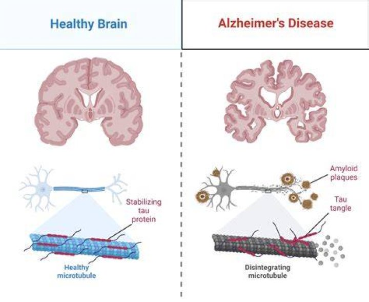 Unraveling The Complexities Of Alzheimer And The Importance Of Early Diagnosis