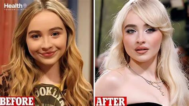 Unraveling The Mystery: Has Sabrina Carpenter Had Filler?
