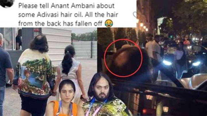 Unraveling The Mystery Of Anant Ambani's Hair Fall