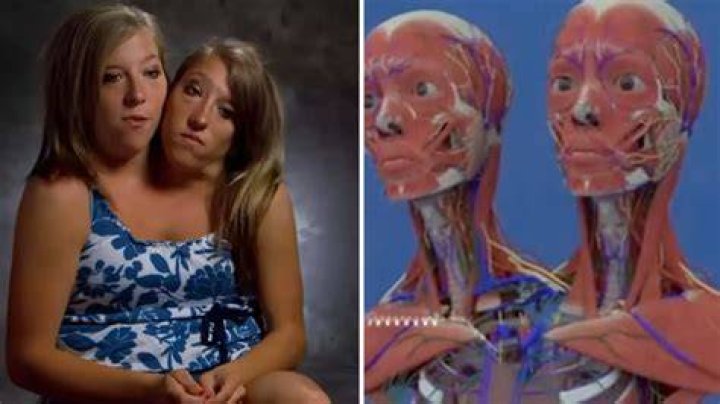 Unveiling The Lives Of Abigail And Brittany Hensel: Are They Pregnant?