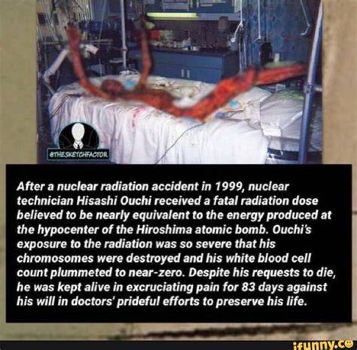Unveiling The Tragic Transformation: Hisashi Ouchi's Face After Radiation