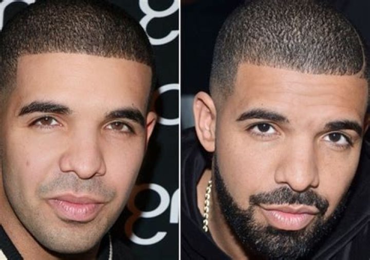 Unveiling The Truth Behind Drake's Nose Surgery