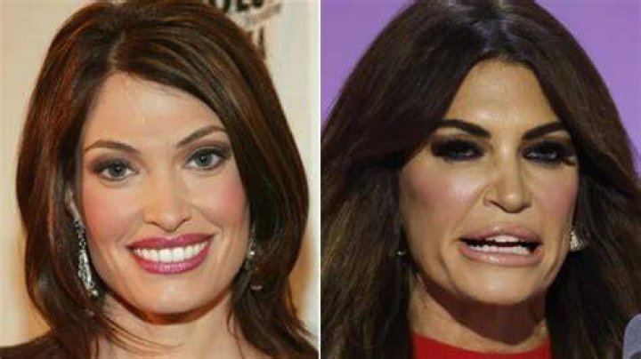 Unveiling The Truth: Has Kimberly Guilfoyle Had Cosmetic Surgery?