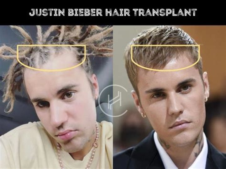 Unveiling The Truth: Justin Bieber Hair Implants