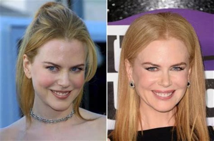 Unveiling The Truth: Nicole Kidman's Facial Transformation