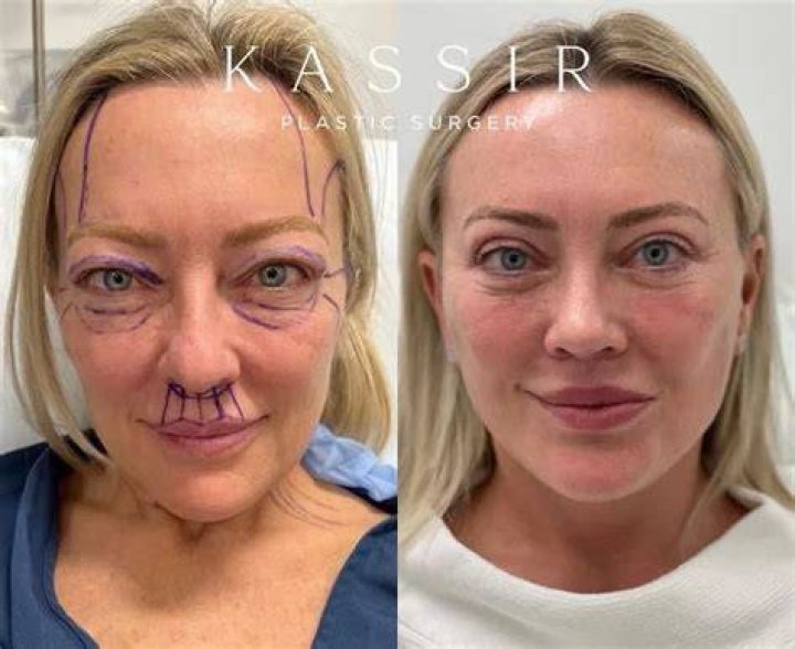 What Happened To Laura Ingraham Face? Face Lift and Plastic Surgery Update